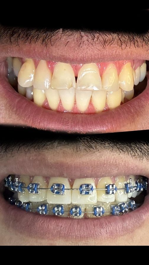 Resultado de tratamiento dental