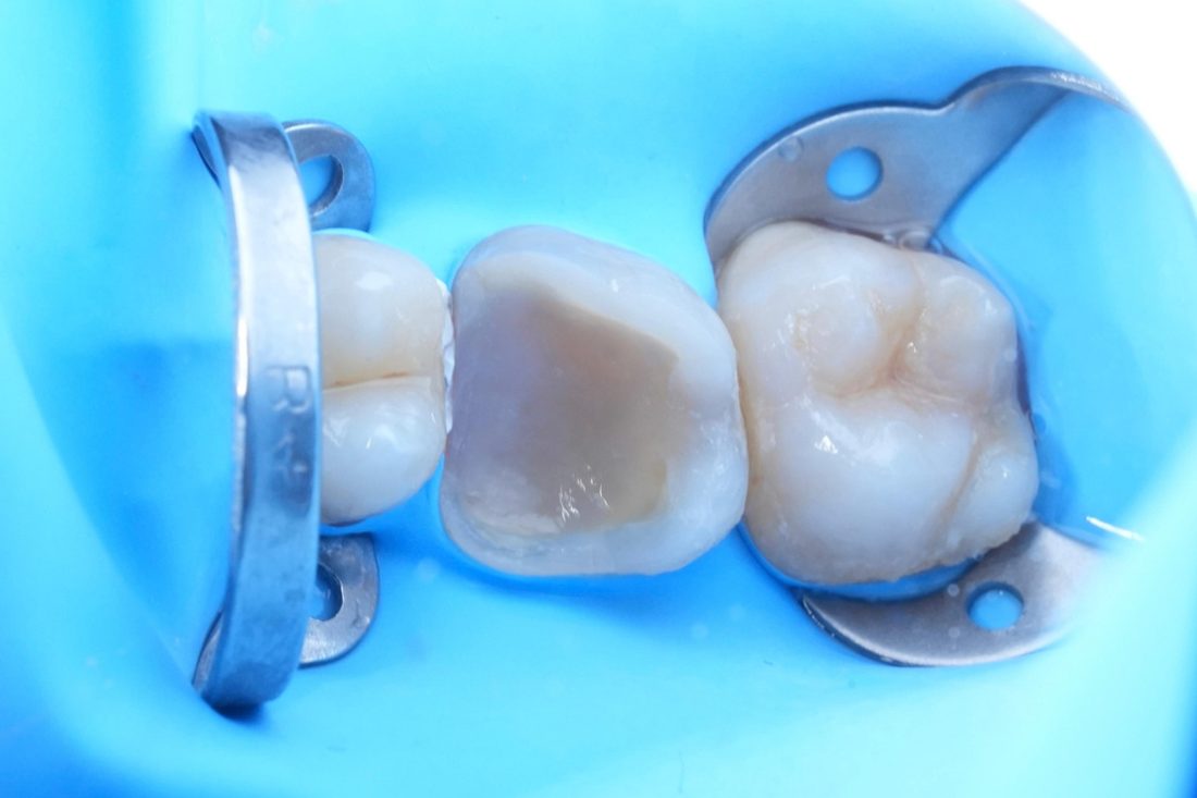 Resultado de tratamiento dental
